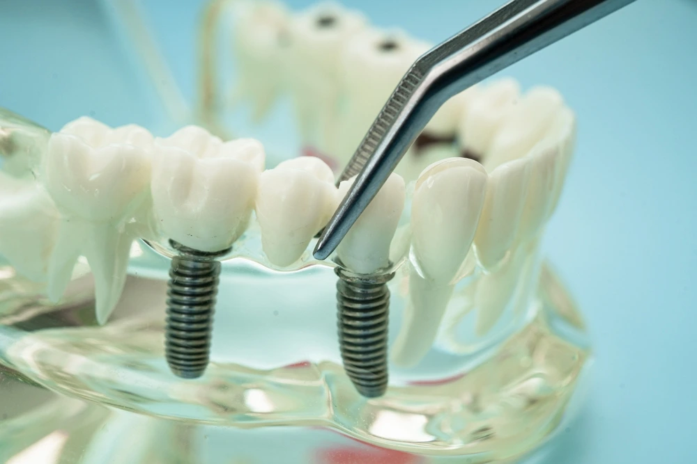 Single Implants vs. Multiple Implants