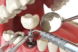 Dental implant process