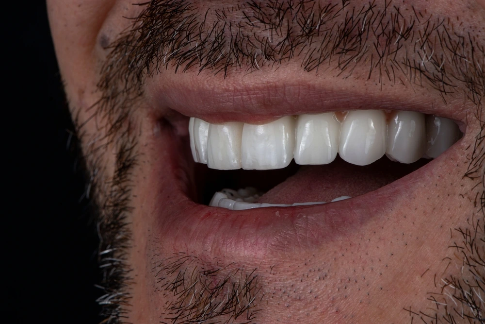 Pros and Cons of same-day implants in Turkey