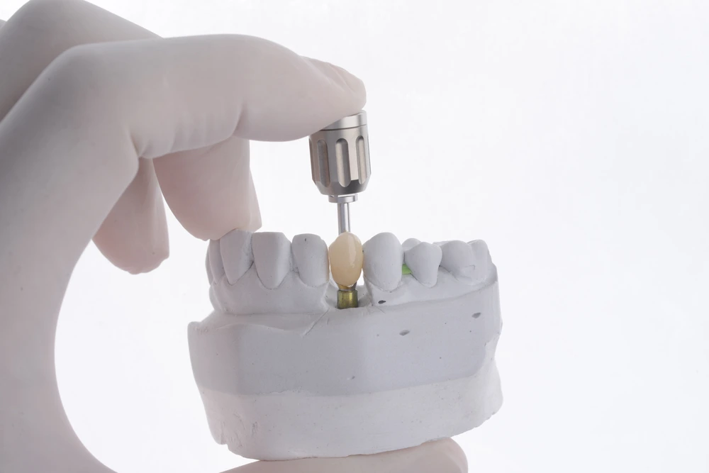 Different types of Dental Implants