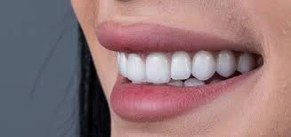 مميزات وعيوب دايركت فينير لابتسامة هوليود