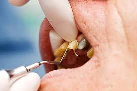 Risks of Dental Implants