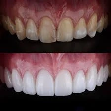 The Difference Between Veneers and a Hollywood Smile