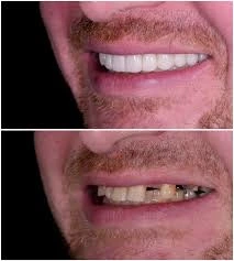 مميزات وعيوب ابتسامة هوليوود والفينير