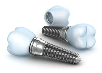 Titanium Dental Implants: Cost, Pros & Cons