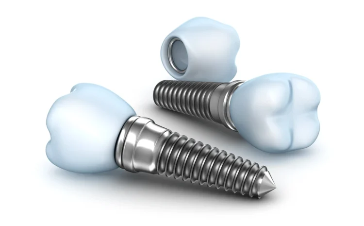 Titanium Dental Implants: Cost, Pros & Cons