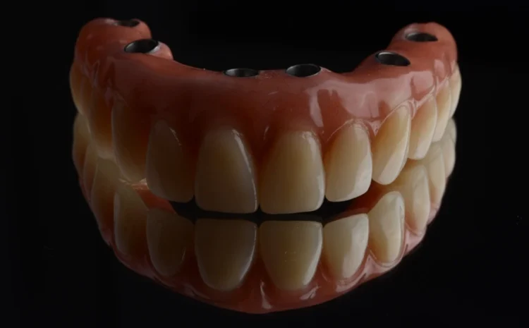 All on 6 Dental Implants: Everything you want to know