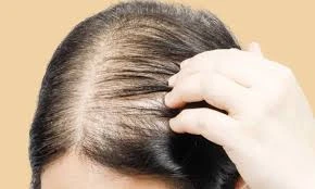 What Causes Hair Loss in Women?