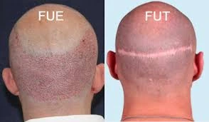 FUE and FUT