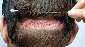 What Is DHI Hair Transplant?