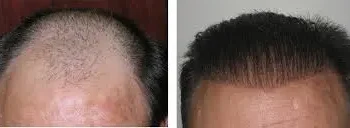 Hair Implant vs Hair Transplant (Full Guide)