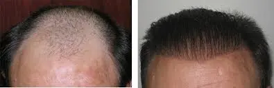 Hair Implant vs Hair Transplant (Full Guide)