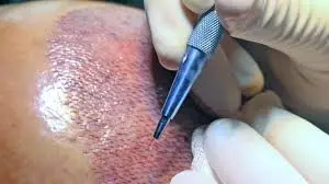 Sapphire FUE Hair Transplant: Everything you want to know