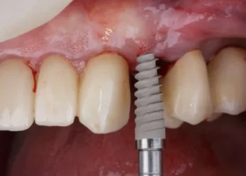 Dental Implants Without Surgery: Is It Possible?