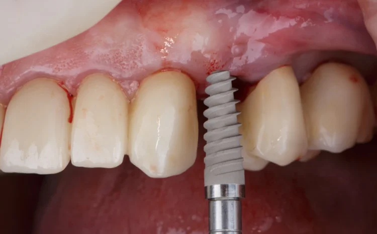 Dental Implants Without Surgery: Is It Possible?