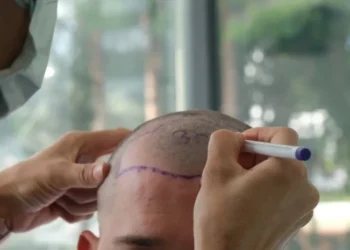 What is a Hair Transplant? Hairline Transplant (Comprehensive Guide)