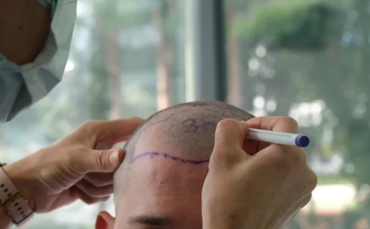 What is a Hair Transplant? Hairline Transplant (Comprehensive Guide)