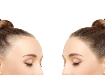 Female Hair Transplant: Causes, Techniques & Cost Explained