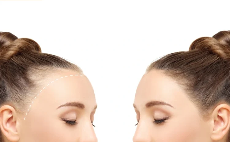 Female Hair Transplant: Causes, Techniques & Cost Explained