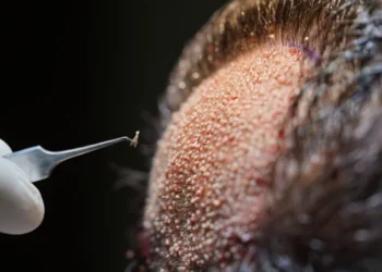 Everything to Know About a FUE Hair Transplant