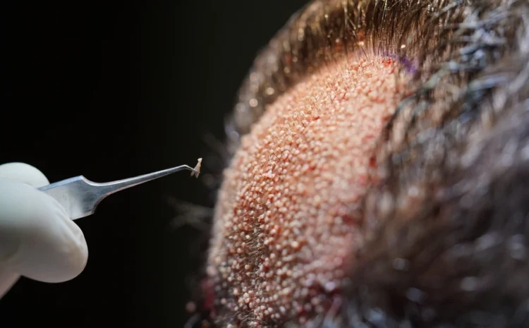 Everything to Know About a FUE Hair Transplant
