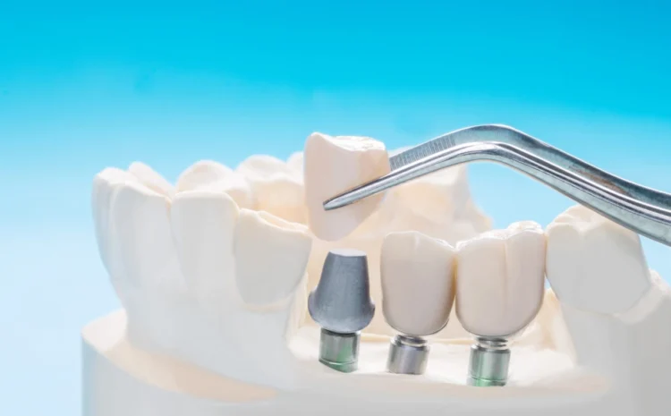 A Dental Implant or a Bridge: What’s Better?