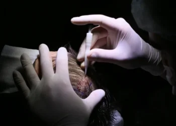 Best DHI Hair Transplant in Turkey: Everything you want to know