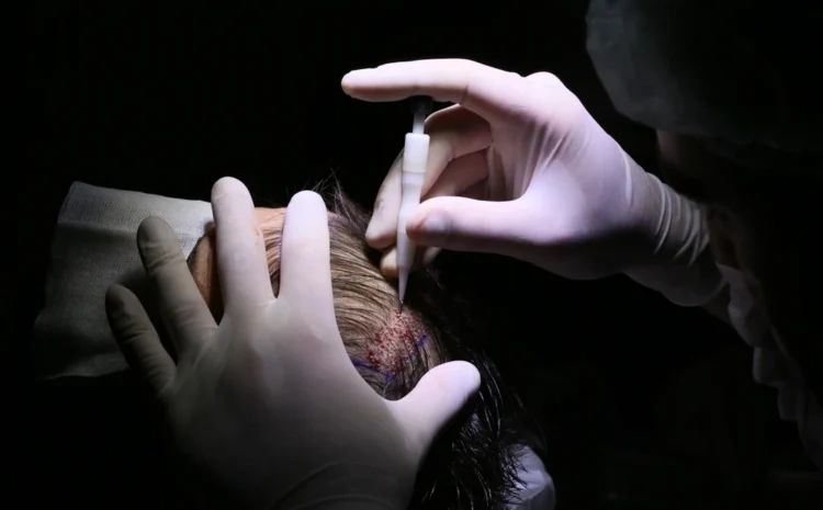 Best DHI Hair Transplant in Turkey: Everything you want to know