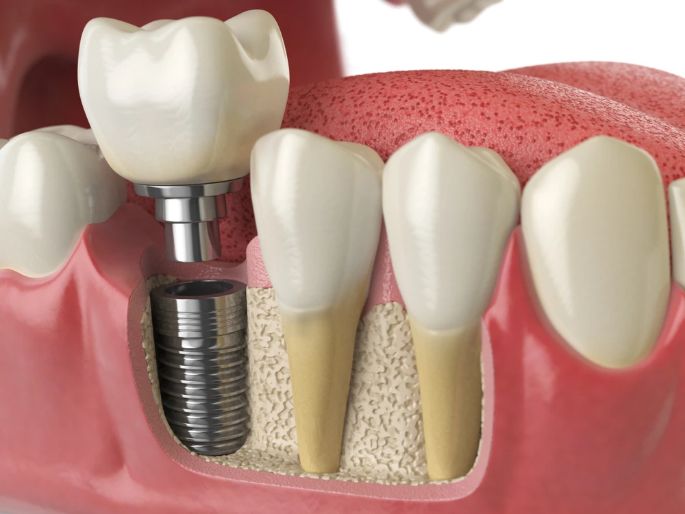 Properties of Titanium Dental Implants