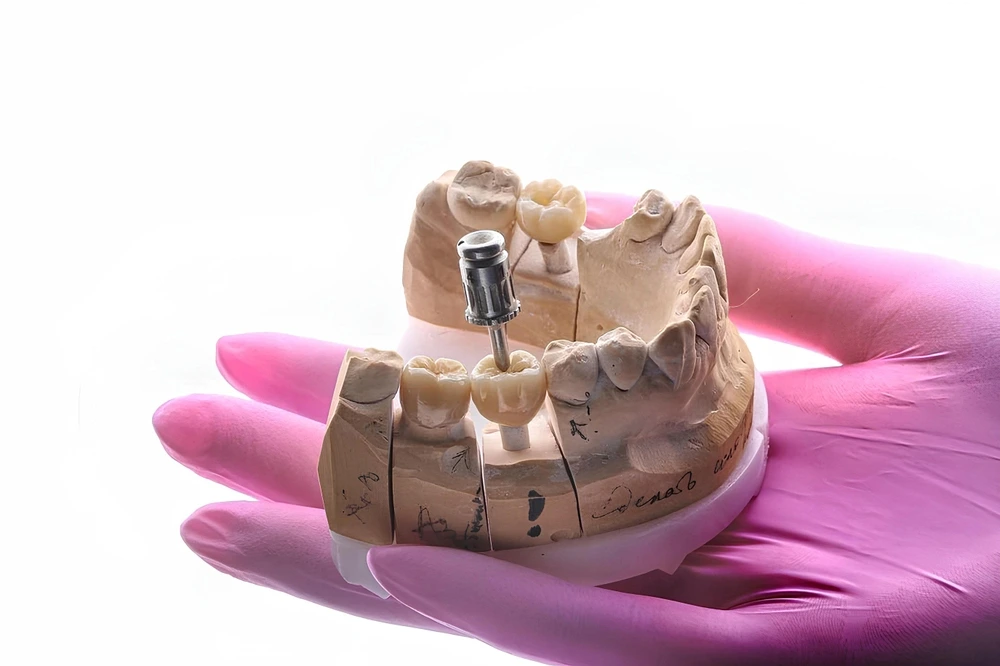 Information about Dental Implants