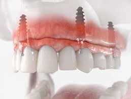What Kinds of Pain Are After Dental Implants?