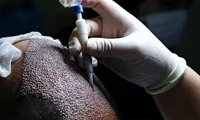 Common types of hair implants for women