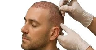 Benefits & Risks of FUE Hair Transplant