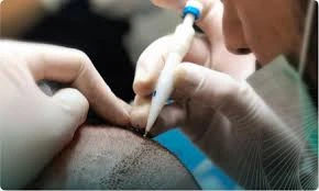 Pros & Cons of DHI hair transplant