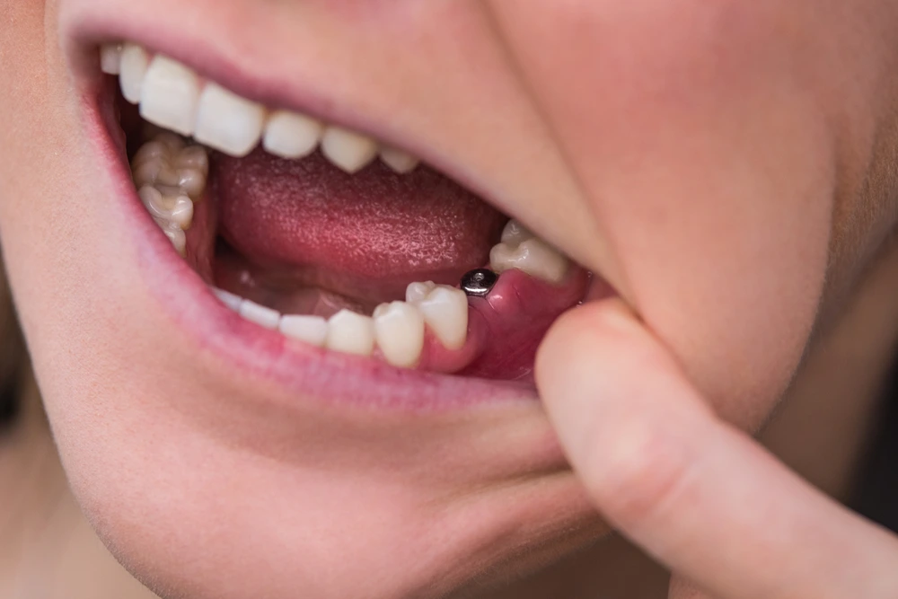 Can You Really Get Dental Implants Without Surgery?