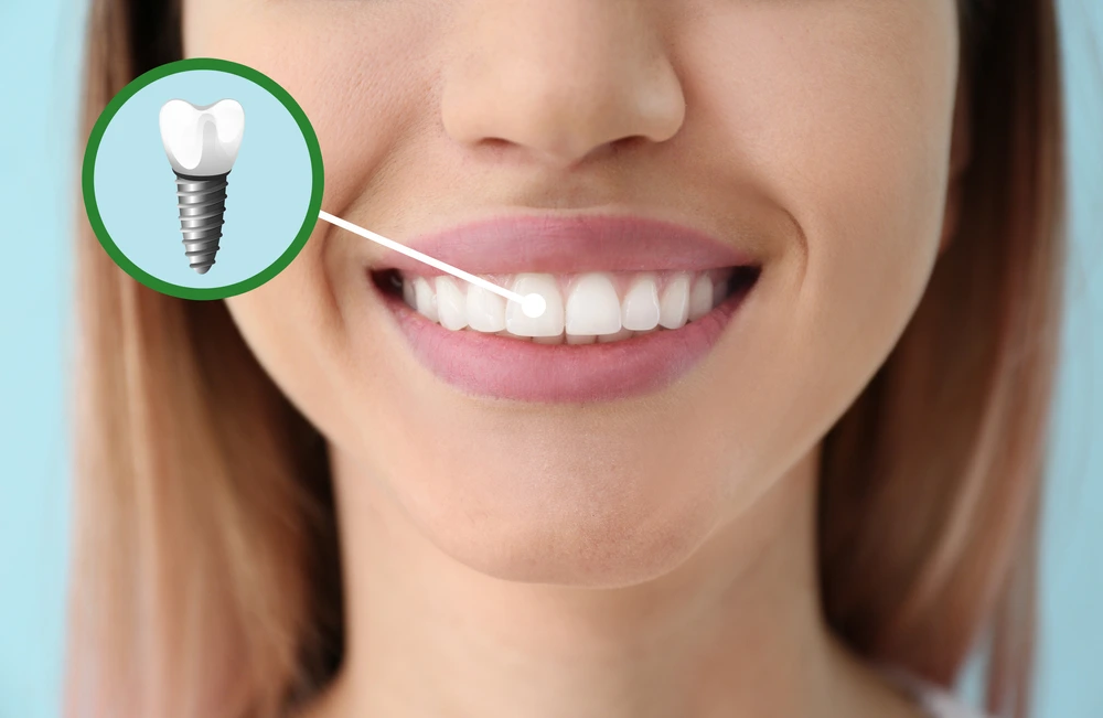 Pros & cons of Titanium Dental Implants