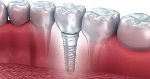 Dental Implant Healing Timeline