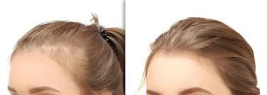 the Best Hair Implants for Women in Turkey