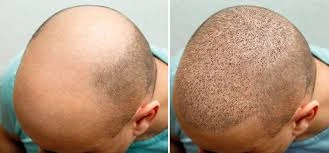 FUE hair transplant turkey before and after