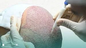 Why DHI Hair Transplant in Turkey Is Booming in 2025?