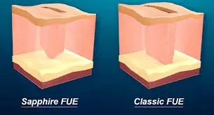 Sapphire FUE vs FUE