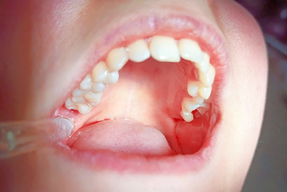Does It Hurt to Get an Implant? What Happens During the Procedure