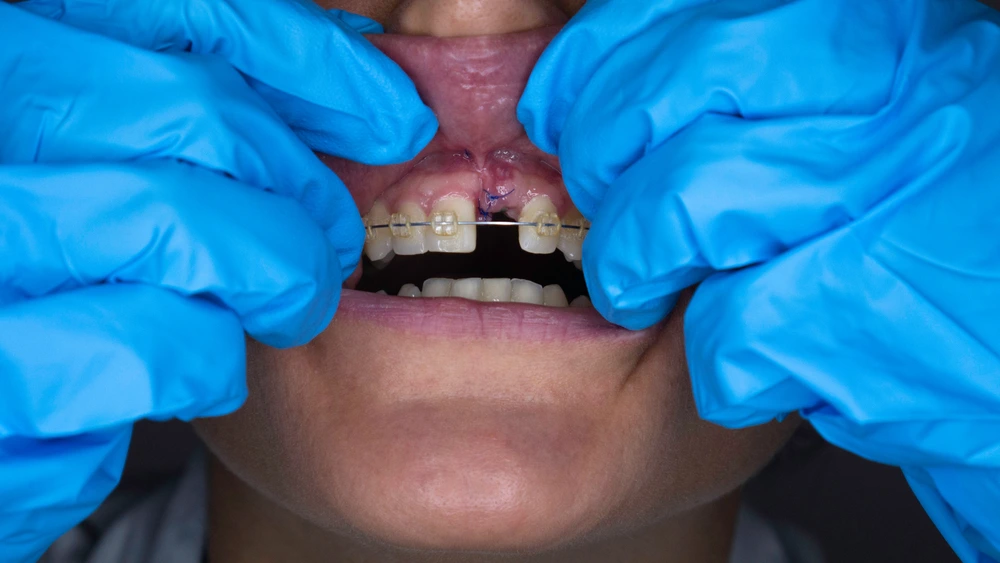 Who Is a Candidate for Non Surgical Dental Implants?