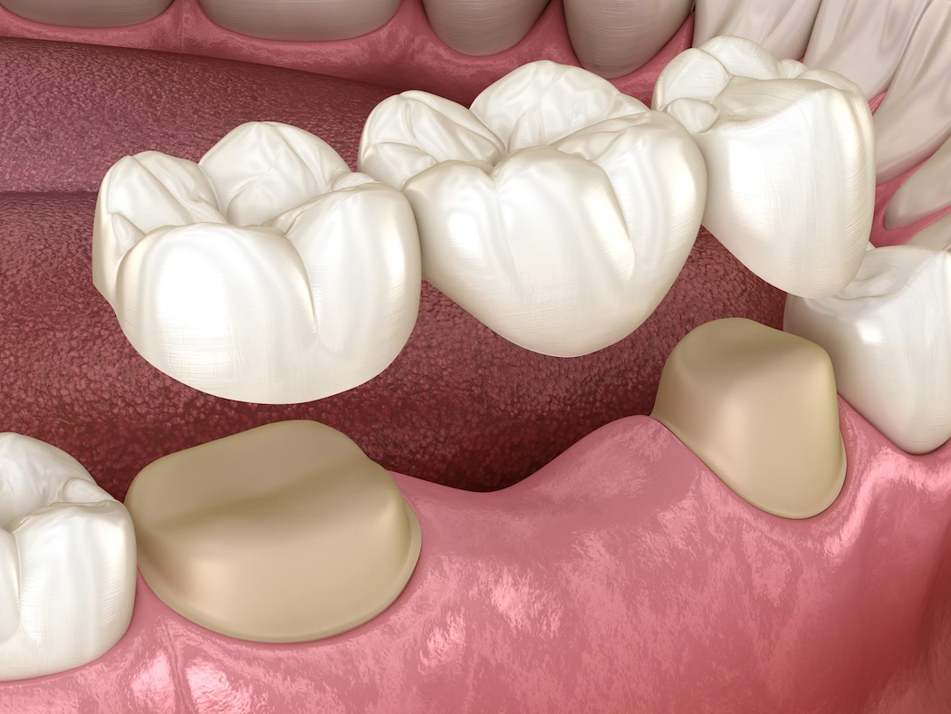 Dental bridges