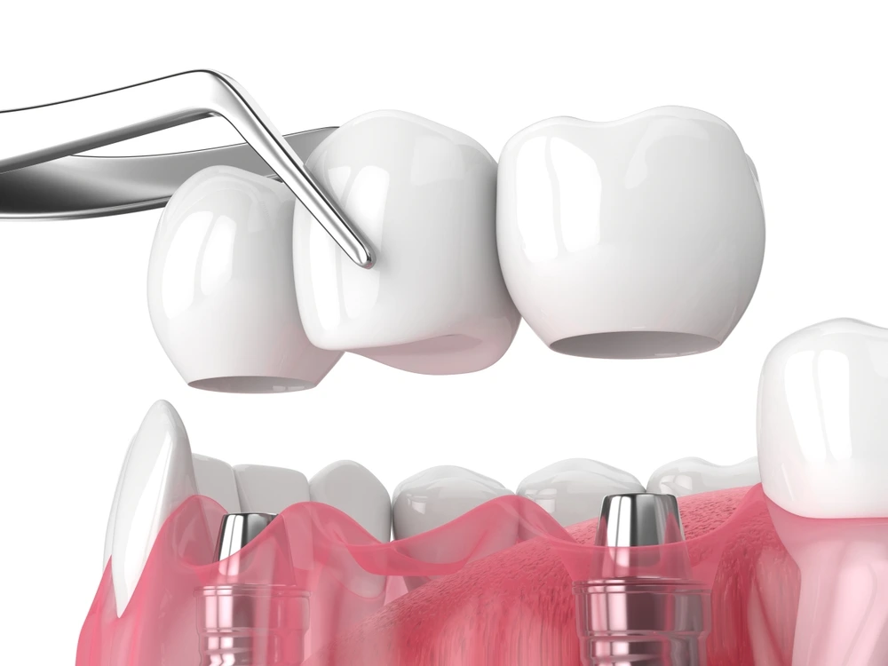 Titanium Dental Implants Vs. Ceramic Dental Implants