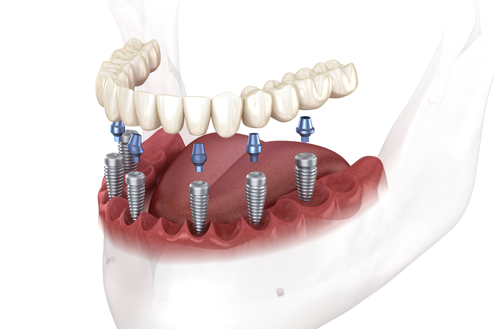 All on 6 Dental Implants Cleaning