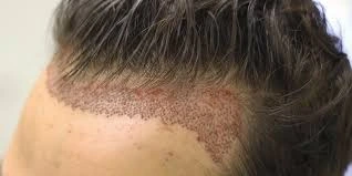 FUE hair transplant procedure