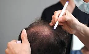 Prof Clinic: Best DHI Hair Transplant Clinic in Turkey
