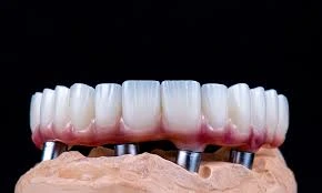 Average Cost of Dental Implants in Turkey