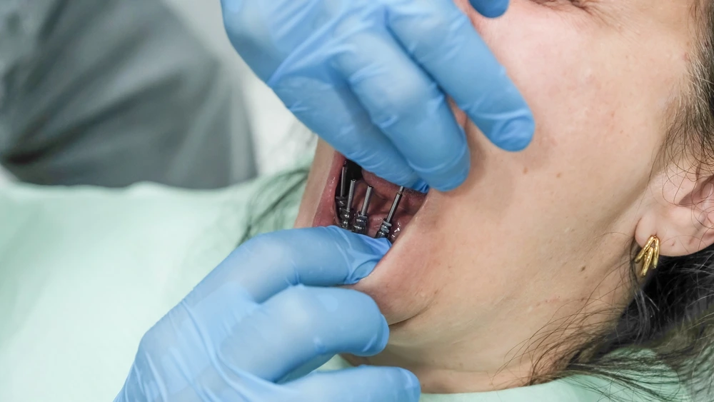 How Does the Non Surgical Dental Implant Procedure Work?